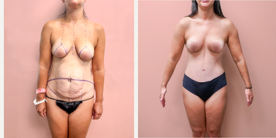 Case 1356 - 25-34 year old woman treated with Tummy Tuck, Breast Lift, Liposuction