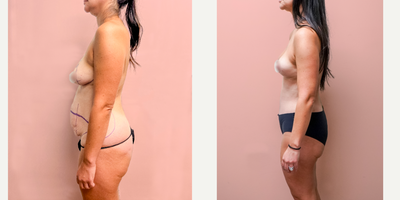 Case 1357 - 25-34 year old woman treated with Tummy Tuck, Breast Lift, Liposuction