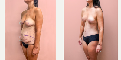 Case 1358 - 25-34 year old woman treated with Tummy Tuck, Breast Lift, Liposuction