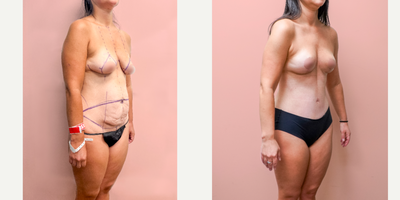 Case 1359 - 25-34 year old woman treated with Tummy Tuck, Breast Lift, Liposuction