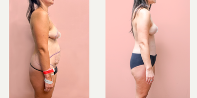 Case 1360 - 25-34 year old woman treated with Tummy Tuck, Breast Lift, Liposuction