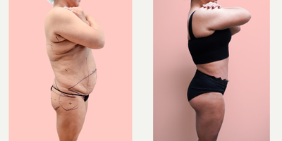 Case 1361 - 35-44 year old woman treated with Tummy Tuck, Tumescent Liposuction, Vaser Liposuction, Brazilian Butt Lift