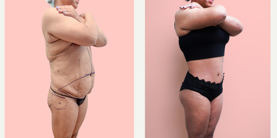 Case 1362 - 35-44 year old woman treated with Tummy Tuck, Tumescent Liposuction, Vaser Liposuction, Brazilian Butt Lift