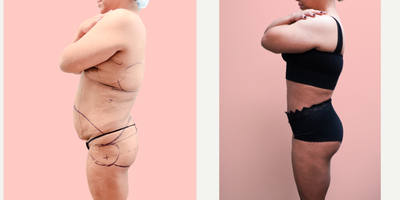 Case 1363 - 35-44 year old woman treated with Tummy Tuck, Tumescent Liposuction, Vaser Liposuction, Brazilian Butt Lift