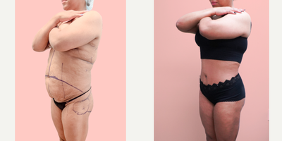 Case 1364 - 35-44 year old woman treated with Tummy Tuck, Tumescent Liposuction, Vaser Liposuction, Brazilian Butt Lift