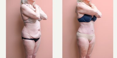 Case 1365 - 55-64 year old woman treated with Tummy Tuck, Tumescent Liposuction