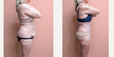 Case 1366 - 55-64 year old woman treated with Tummy Tuck, Tumescent Liposuction