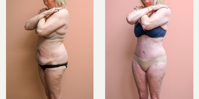 Case 1367 - 55-64 year old woman treated with Tummy Tuck, Tumescent Liposuction