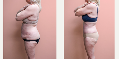 Case 1368 - 55-64 year old woman treated with Tummy Tuck, Tumescent Liposuction