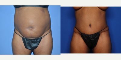 Case 1369 - 45-54 year old woman treated with Tummy Tuck