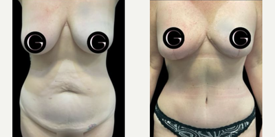 Case 137 - Woman treated with Tummy Tuck