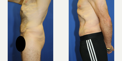 Case 1370 - 45-54 year old woman treated with Tummy Tuck