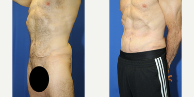 Case 1371 - 45-54 year old woman treated with Tummy Tuck