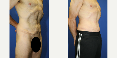 Case 1373 - 45-54 year old woman treated with Tummy Tuck