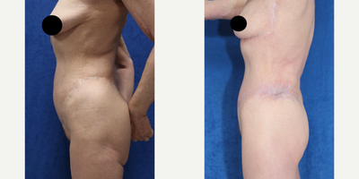 Case 1374 - 65-74 year old woman treated with Tummy Tuck