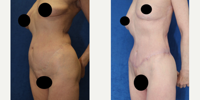 Case 1375 - 65-74 year old woman treated with Tummy Tuck