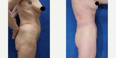 Case 1376 - 65-74 year old woman treated with Tummy Tuck