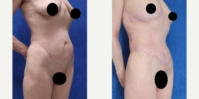 Case 1377 - 65-74 year old woman treated with Tummy Tuck