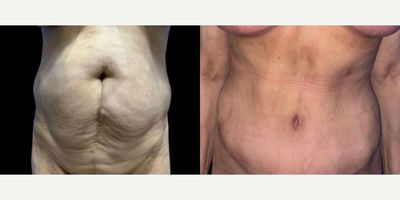 Case 138 - Woman treated with Tummy Tuck