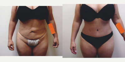 Case 1380 - 45-54 year old woman treated with Tummy Tuck