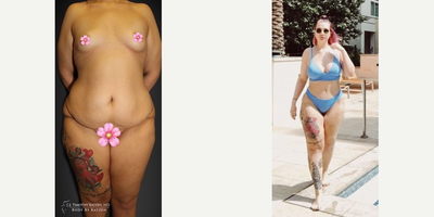 Case 1381 - Tummy Tuck