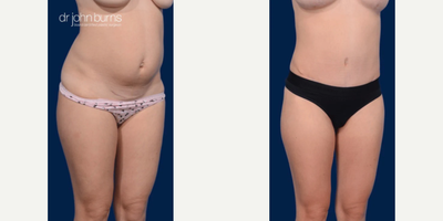 Case 1382 - Woman treated with Tummy Tuck