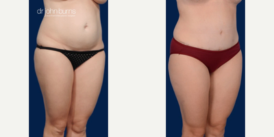 Case 1383 - Woman treated with Tummy Tuck