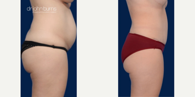 Case 1384 - Woman treated with Tummy Tuck