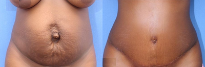 Case 1389 - Woman treated with Tummy Tuck