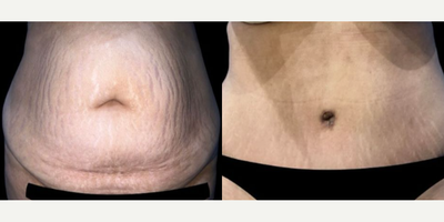 Case 139 - Woman treated with Tummy Tuck