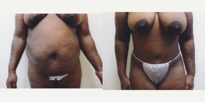 Case 1397 - 35-44 year old woman treated with Tummy Tuck