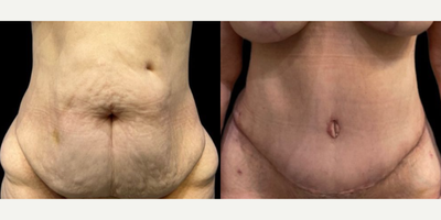 Case 140 - Woman treated with Tummy Tuck