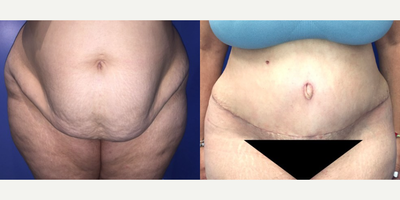 Case 1401 - Woman treated with Tummy Tuck