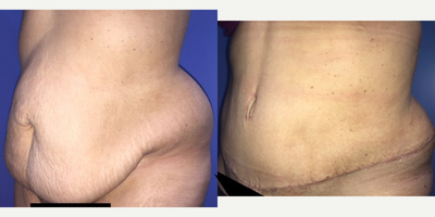 Case 1402 - Woman treated with Tummy Tuck