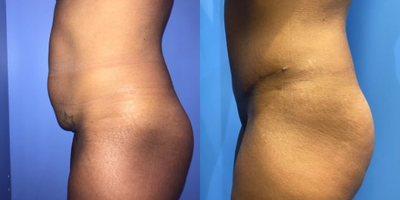 Case 1403 - Woman treated with Tummy Tuck