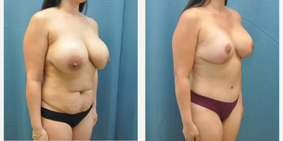 Case 1408 - Woman treated with Mommy Makeover, Tummy Tuck