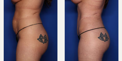 Case 1410 - 39 year old woman treated with Tummy Tuck, Liposuction