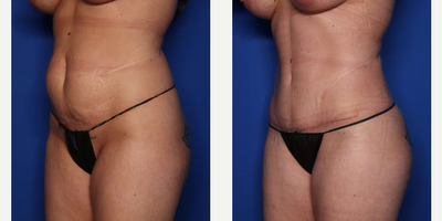 Case 1411 - 39 year old woman treated with Tummy Tuck, Liposuction