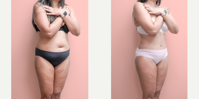 Case 1412 - 35-44 year old woman treated with Tummy Tuck, Tumescent Liposuction