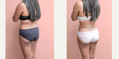 Case 1413 - 35-44 year old woman treated with Tummy Tuck, Tumescent Liposuction