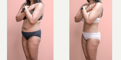 Case 1414 - 35-44 year old woman treated with Tummy Tuck, Tumescent Liposuction