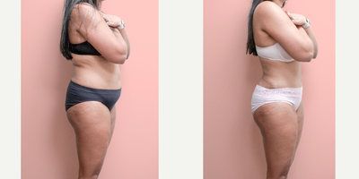 Case 1415 - 35-44 year old woman treated with Tummy Tuck, Tumescent Liposuction