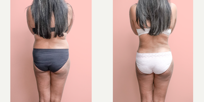 Case 1416 - 35-44 year old woman treated with Tummy Tuck, Tumescent Liposuction