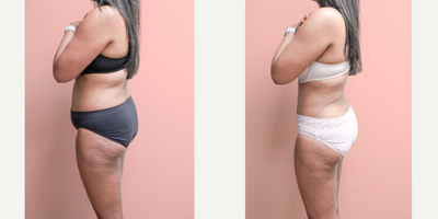 Case 1417 - 35-44 year old woman treated with Tummy Tuck, Tumescent Liposuction