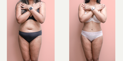 Case 1418 - 35-44 year old woman treated with Tummy Tuck, Tumescent Liposuction