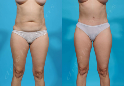 Case 1419 - 25-34 year old woman treated with Tummy Tuck