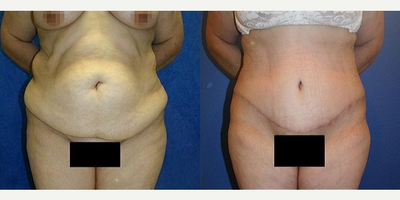 Case 1420 - Tummy Tuck