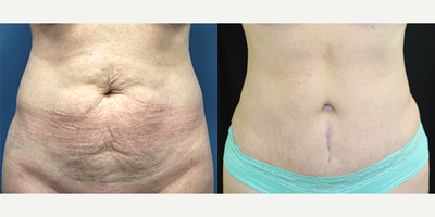 Case 1421 - 45-54 year old woman treated with Tummy Tuck