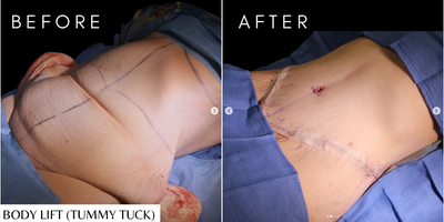 Case 1422 - Woman treated with Body Lift, Tummy Tuck
