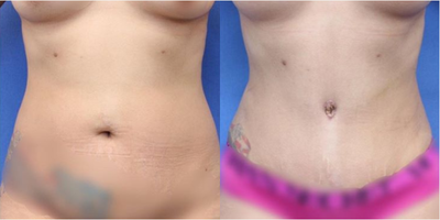 Case 1423 - Woman treated with Tummy Tuck